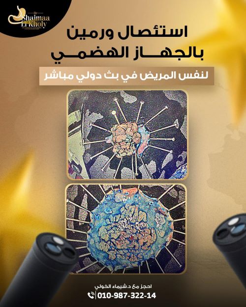 ازلة ورمين لنفس الشخص في نفس العملية